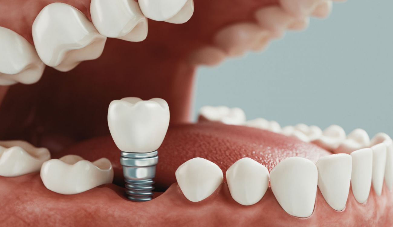 dentista estetico gijon