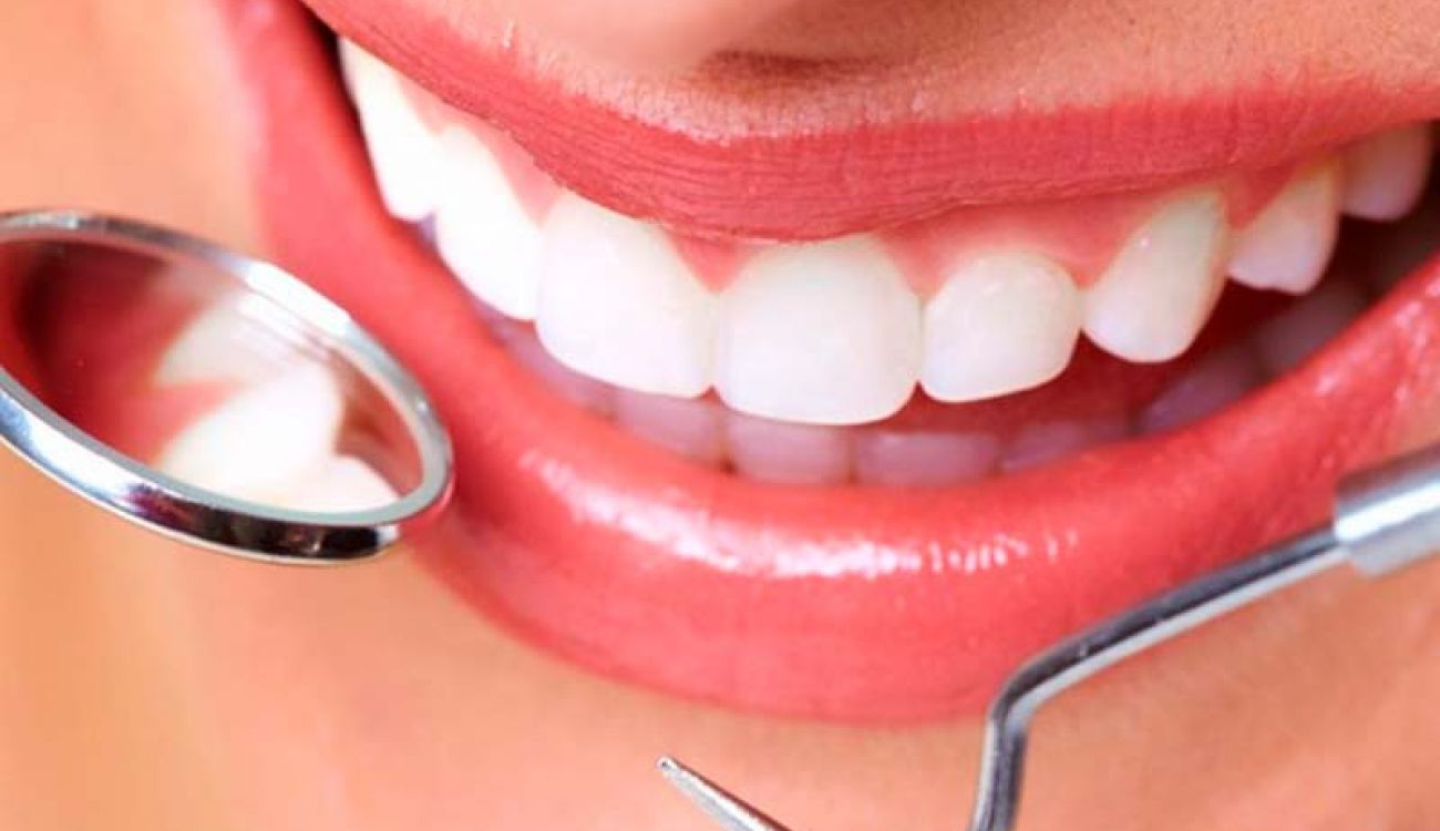 profilaxis dental gijon