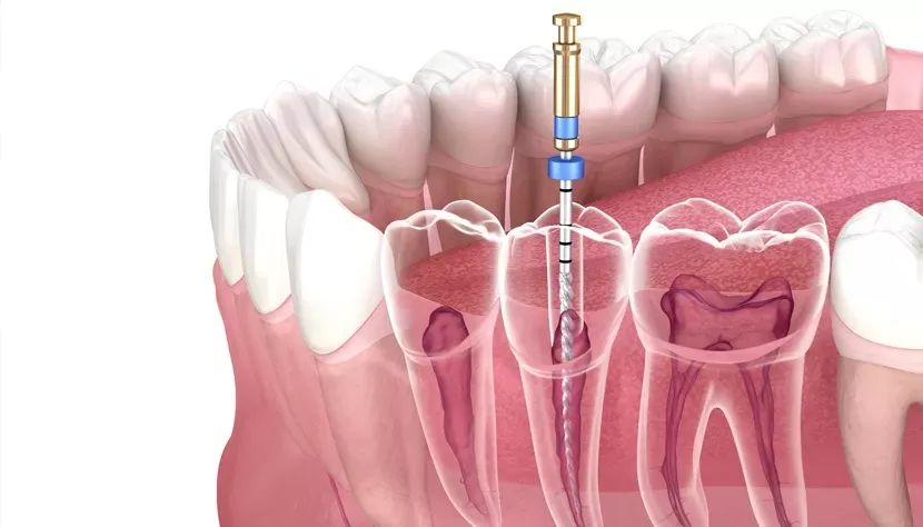 Endodoncia